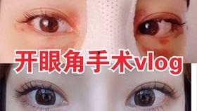如何开眼角视频全过程,轻松掌握开眼角技巧全解析